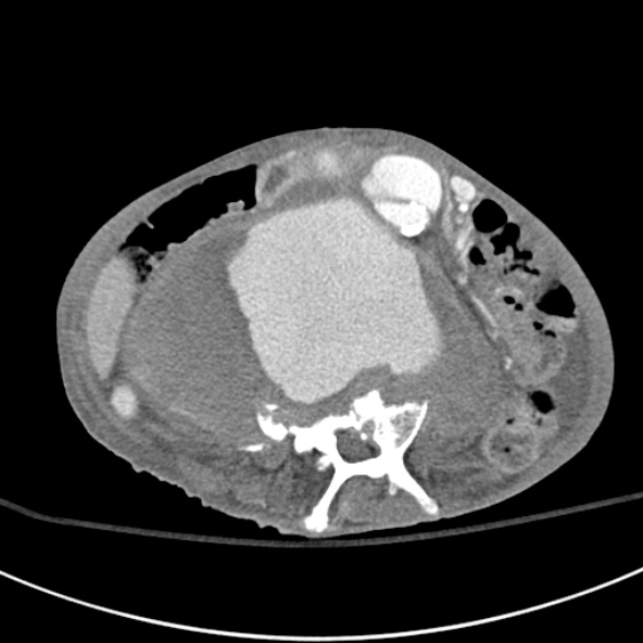 File:Aortic aneurysm with spinal destruction (Radiopaedia 42301-45410 A 53).jpg