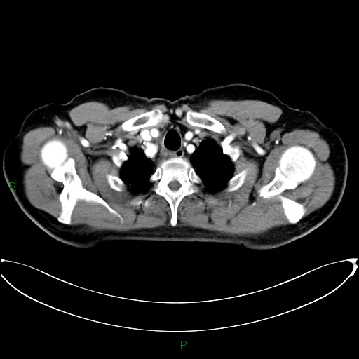 File:Aortic arch origin of left vertebral artery (Radiopaedia 46327-50737 Axial post contrast 14).jpg