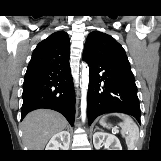 File:Aortic arch stent (Radiopaedia 30030-30595 F 24).jpg