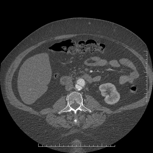 File:Aortic dissection- Stanford A (Radiopaedia 35729-37268 C 11).jpg