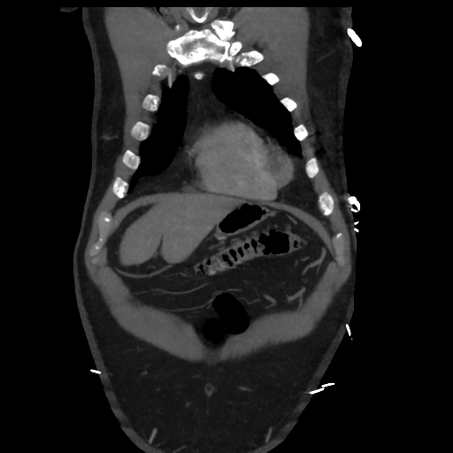 File:Aortic dissection- Stanford A (Radiopaedia 37759-39664 Coronal C+ delayed 3).png