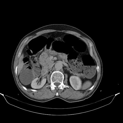 File:Aortic dissection- Stanford type A (Radiopaedia 22085-22085 Axial C+ delayed 19).jpg