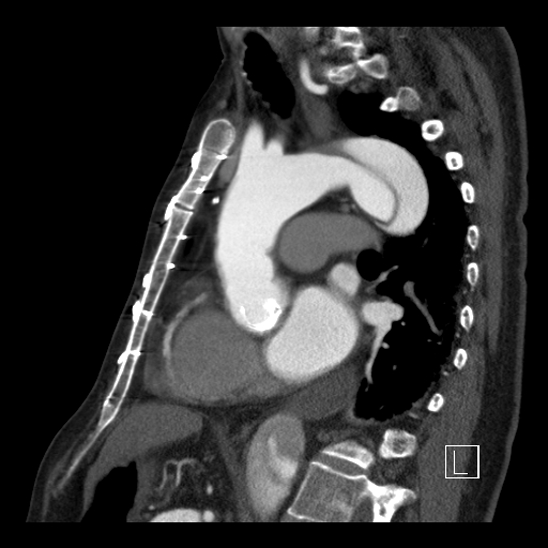 File:Aortic dissection (CTPA) (Radiopaedia 75506-86750 C 60).jpg