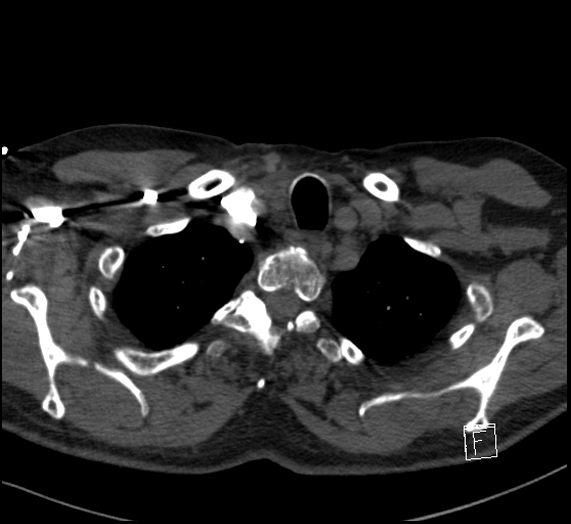 Aortic dissection (CTPA) (Radiopaedia 75506-86751 Axial C+ CTPA 17).jpg