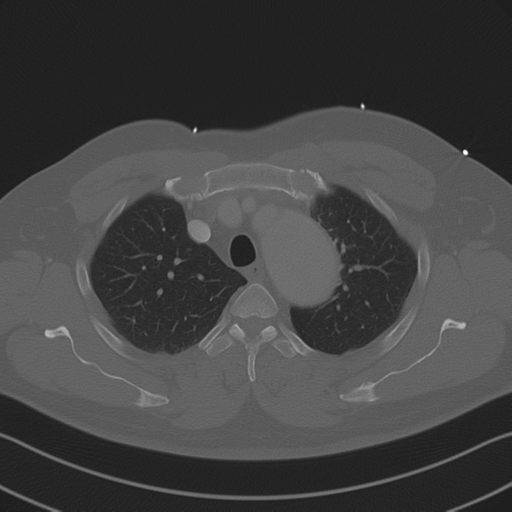 File:Aortic dissection (Radiopaedia 50763-56234 Axial bone window 30).png
