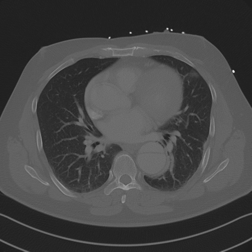Aortic dissection (Radiopaedia 50763-56234 Axial bone window 58).png
