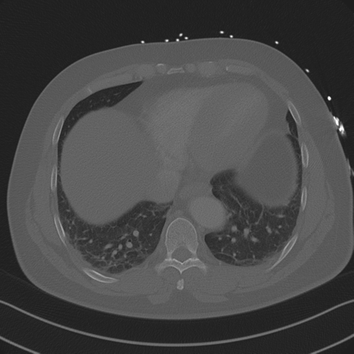 Aortic dissection (Radiopaedia 50763-56234 Axial bone window 77).png