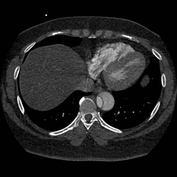 File:Aortic dissection (Radiopaedia 57969-64959 A 227).jpg