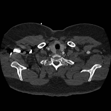 Aortic dissection (Radiopaedia 57969-64959 A 24).jpg