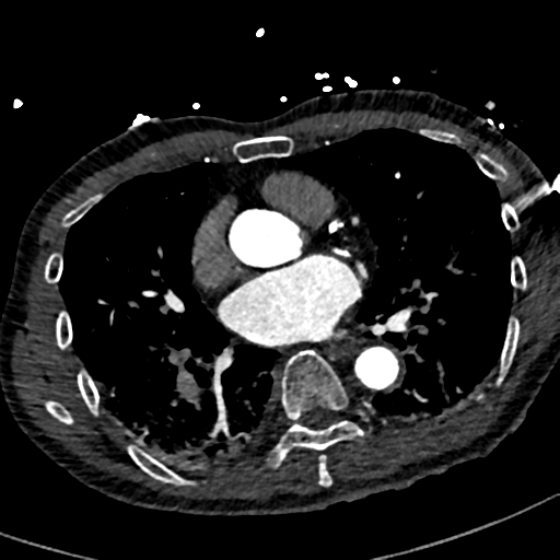File:Aortic dissection - DeBakey type II (Radiopaedia 64302-73082 A 50).png