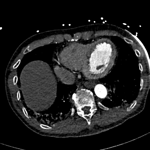 File:Aortic dissection - DeBakey type II (Radiopaedia 64302-73082 A 69).png