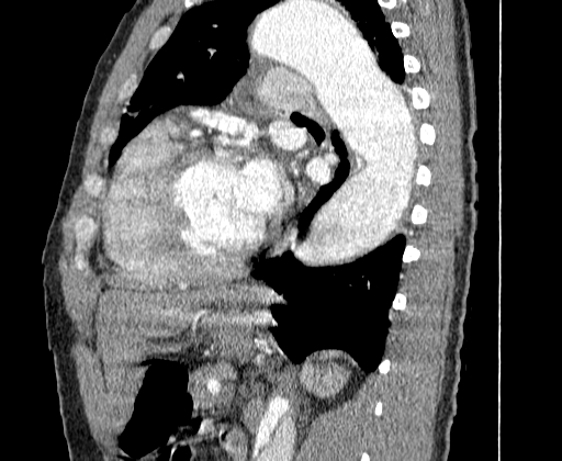 Aortic dissection - Stanford A -DeBakey I (Radiopaedia 28339-28587 C 55).jpg