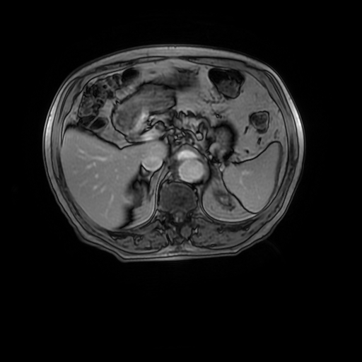 Aortic dissection - Stanford A - DeBakey I (Radiopaedia 23469-23551 Axial MRA 41).jpg
