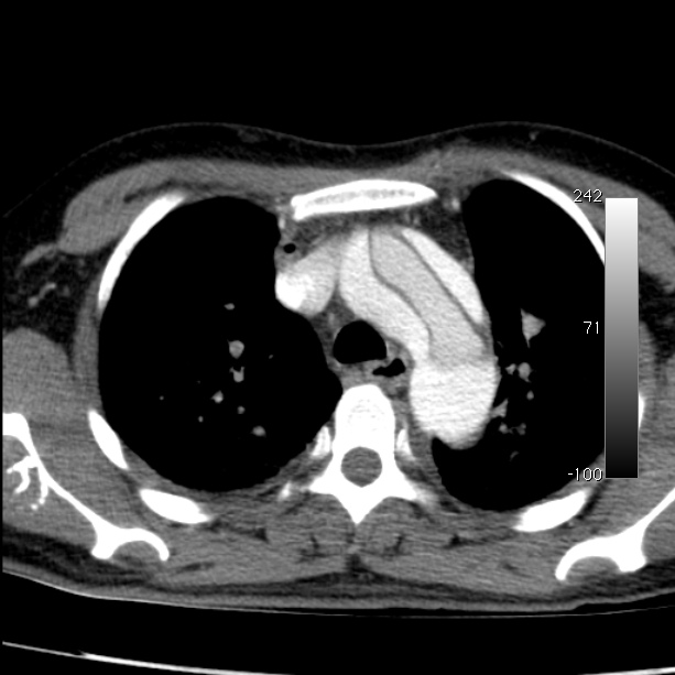 Aortic dissection - Stanford type A (Radiopaedia 29247-29659 A 22).jpg
