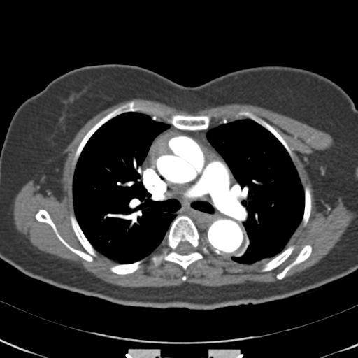 File:Aortic dissection - Stanford type A (Radiopaedia 39073-41259 A 31).png