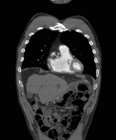 File:Aortic dissection - Stanford type B (Radiopaedia 73648-84437 B 29).jpg