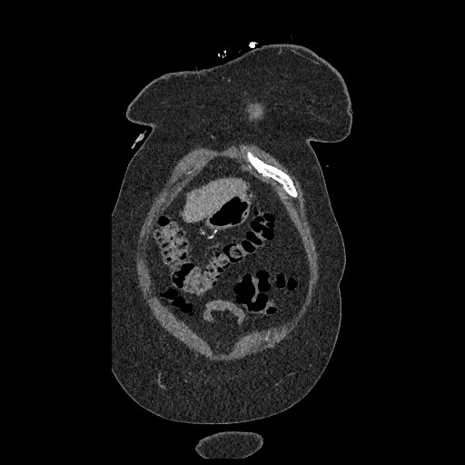 File:Aortic dissection - Stanford type B (Radiopaedia 88281-104910 B 5).jpg