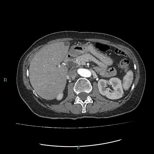 File:Aortic dissection extended to lusory artery (Radiopaedia 43686-47136 B 16).jpg
