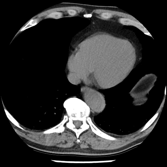 Aortic intramural hematoma (type B) (Radiopaedia 79323-92387 Axial non-contrast 40).jpg