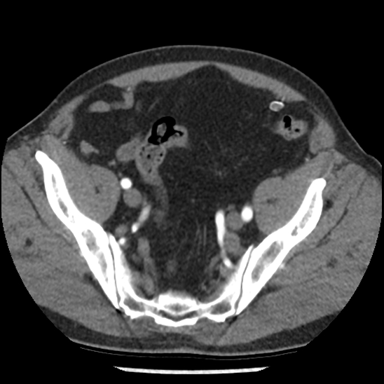 Aortic intramural hematoma (type B) (Radiopaedia 79323-92387 B 99).jpg