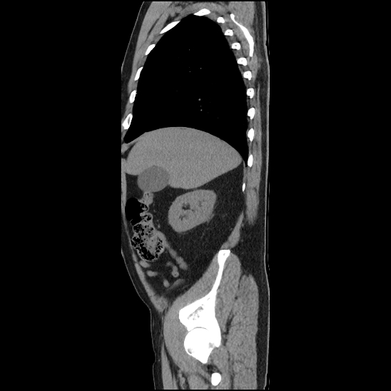 Aortic intramural hematoma (type B) (Radiopaedia 79323-92387 G 6).jpg