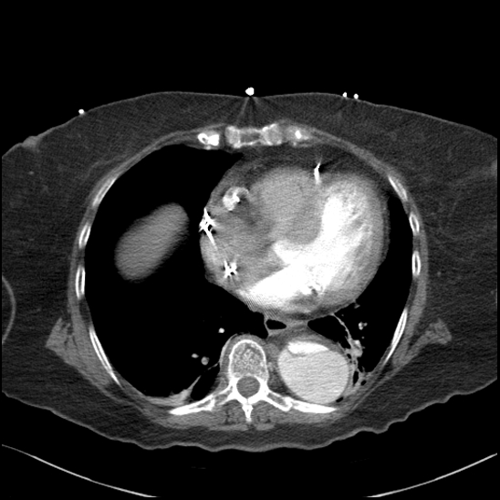 Aortic intramural hematoma with dissection and intramural blood pool (Radiopaedia 77373-89491 B 77).jpg
