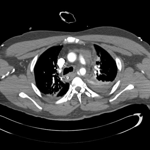 Aortic transection, diaphragmatic rupture and hemoperitoneum in a complex multitrauma patient (Radiopaedia 31701-32622 A 32).jpg
