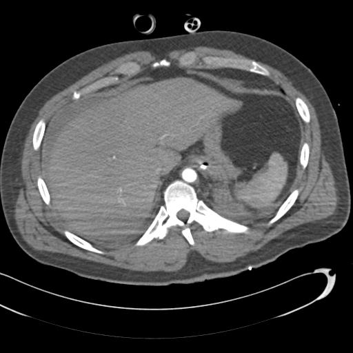 Aortic transection, diaphragmatic rupture and hemoperitoneum in a complex multitrauma patient (Radiopaedia 31701-32622 A 76).jpg