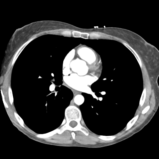 Aortic valve non-coronary cusp thrombus (Radiopaedia 55661-62189 B 27).png