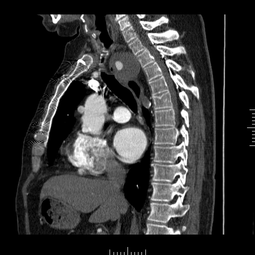 File:Aorto-coronary bypass graft aneurysms (Radiopaedia 40562-43157 C 15).png