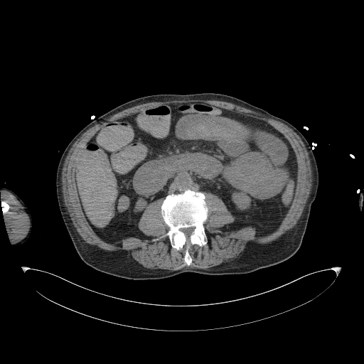 Aortoduodenal fistula (Radiopaedia 75286-86415 Axial non-contrast 36).jpg