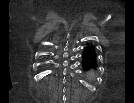 Aortoesophageal fistula with endovascular repair (Radiopaedia 73781-84592 Coronal C+ CTPA 126).jpg