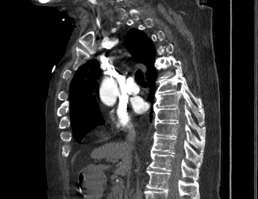 Aortoesophageal fistula with endovascular repair (Radiopaedia 73781-84592 Sagittal C+ CTPA 87).jpg