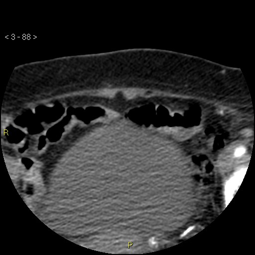 File:Aortoiliac occlusive disease (Radiopaedia 16828-16548 A 88).jpg