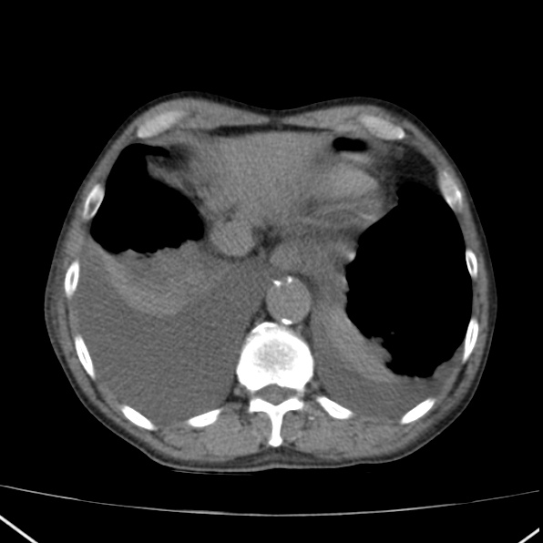 Aortoiliac occlusive disease (Radiopaedia 32134-33076 Axial non-contrast 6).jpg