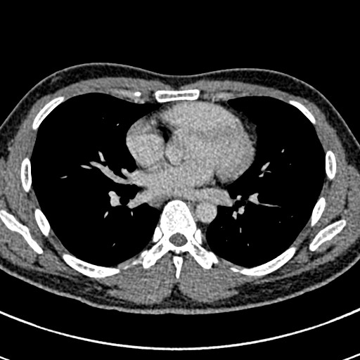 Apical lung mass mimic - neurogenic tumor (Radiopaedia 59918-67521 A 45).jpg