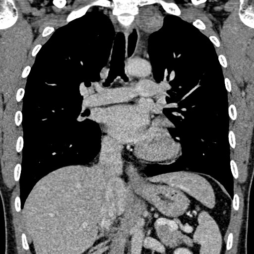 File:Apical lung mass mimic - neurogenic tumor (Radiopaedia 59918-67521 B 64).jpg