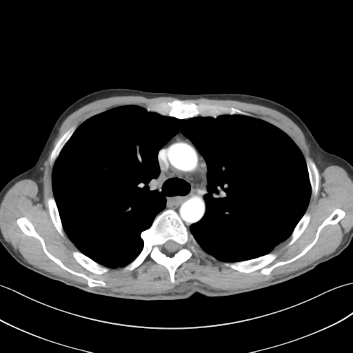 Apical pleural calcification (Radiopaedia 46141-50499 Axial C+ delayed 24).png