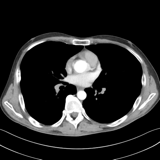 File:Apical pleural calcification (Radiopaedia 46141-50499 Axial C+ delayed 36).png