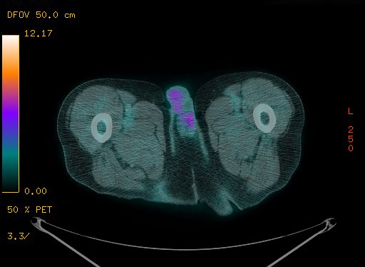 File:Appendiceal adenocarcinoma complicated by retroperitoneal abscess (Radiopaedia 58007-65041 Axial PET-CT 212).jpg