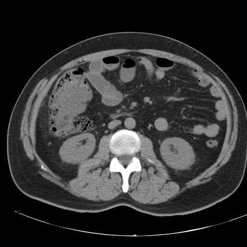 Appendicitis and giant appendicolith (Radiopaedia 80251-93588 Axial non-contrast 26).jpg