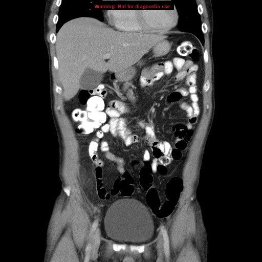 File:Appendicitis and renal cell carcinoma (Radiopaedia 17063-16760 B 10).jpg