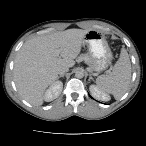 File:Appendicitis complicated by post-operative collection (Radiopaedia 35595-37113 A 14).jpg