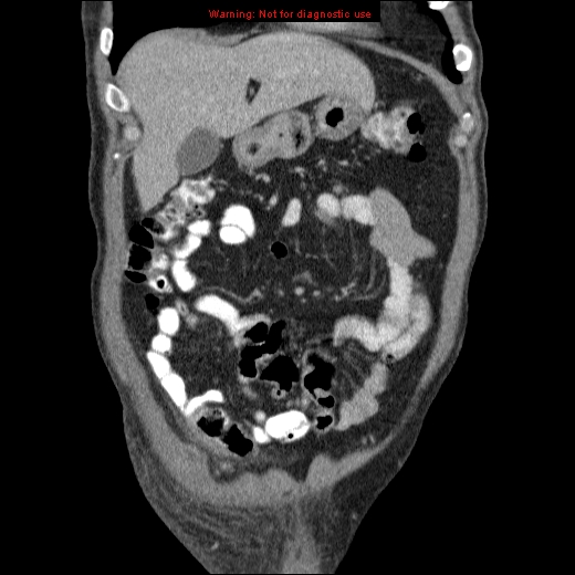 File:Appendicitis mass in inguinal hernia (Radiopaedia 26858-27029 B 14).jpg