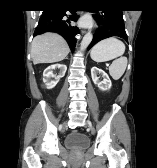 Appendicitis with localized perforation and abscess formation (Radiopaedia 49035-54130 B 32).jpg