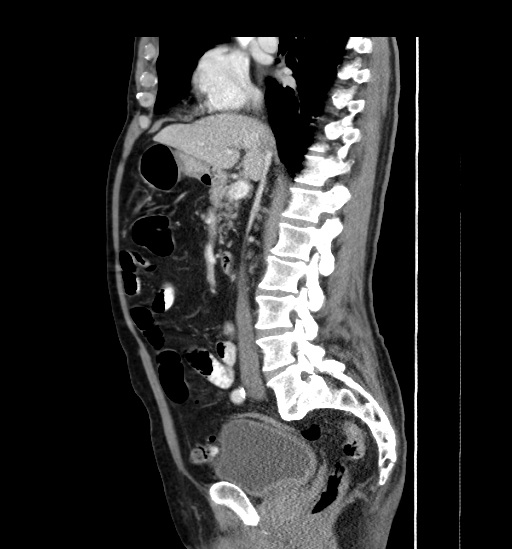File:Appendicitis with localized perforation and abscess formation (Radiopaedia 49035-54130 C 29).jpg