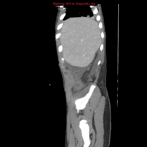 File:Appendicitis with phlegmon (Radiopaedia 9358-10046 F 2).jpg