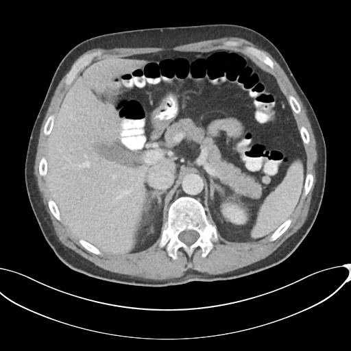 Appendicitis with thickening of the terminal ileum (Radiopaedia 42432-45550 A 27).png