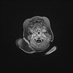 Aqueductal stenosis (Radiopaedia 73974-84802 Axial T1 C+ 13).jpg