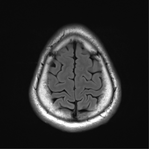 File:Arachnoid cyst - cerebellopontine angle (Radiopaedia 59689-67083 Axial FLAIR 33).png